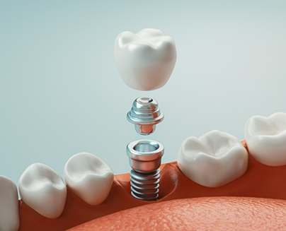 Illustration of a dental implant being placed in the lower jawbone