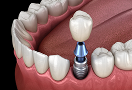 Illustration of a dental crown being fixed onto a dental implant