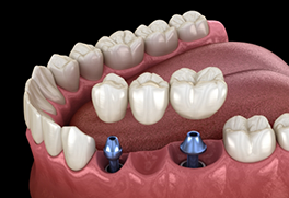 Illustration of a dental bridge being fixed onto two dental implants