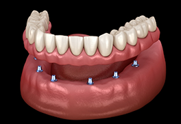 Illustration of a full denture being fixed onto six dental implants