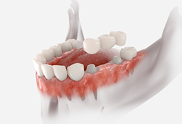 Illustration of a dental bridge replacing a missing tooth