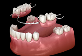 Illustration of a partial denture replacing several missing teeth along an arch