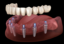 Illustration of a full denture supported by six dental implants