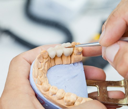 dentist crafting a dental bridge 