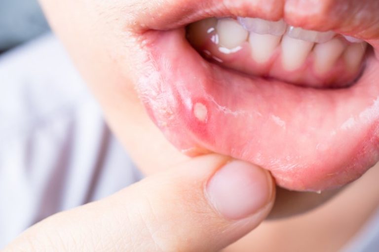 painful-bumps-in-the-mouth-a-dentist-explains-what-they-are