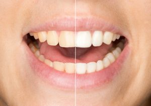 Learn more about teeth whitening in Midlothian for the holidays.